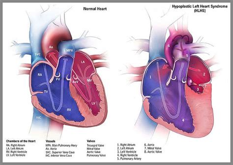 Texas Childrens Now Treating Hypoplastic Left Heart Syndrome