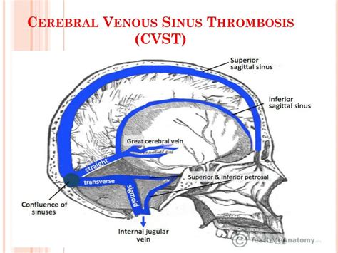 Ppt A Case Of Cerebral Venous Sinus Thrombosis Cvst Powerpoint My Xxx Hot Girl