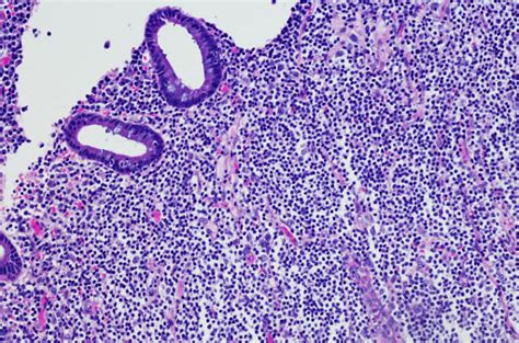 Mucosaassociated Lymphoid Tissue Nonhodgkin Lymphoma Stock Photo