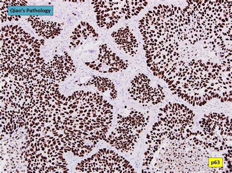 Qiaos Pathology Basaloid Squamous Cell Lung Carcinoma Flickr