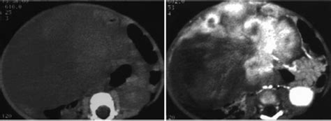 A Unenhanced Ct Scan Shows A Well Defined Relatively Homogeneous