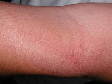 Red Itchy Rash On Arms