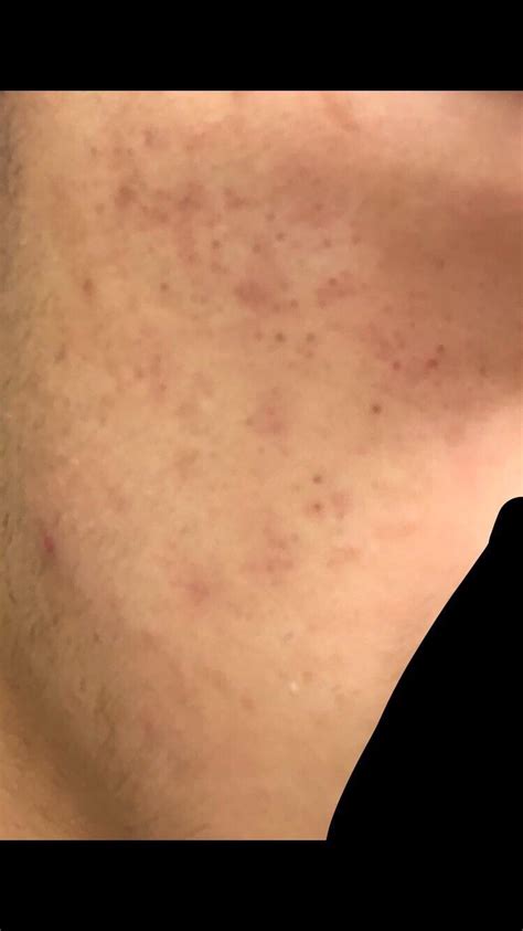 Routine Help Any Advice On How To Get Rid Of My Acne R