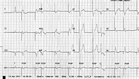Pacemaker Rhythms Normal Patterns Litfl Ecg Library Diagnosis