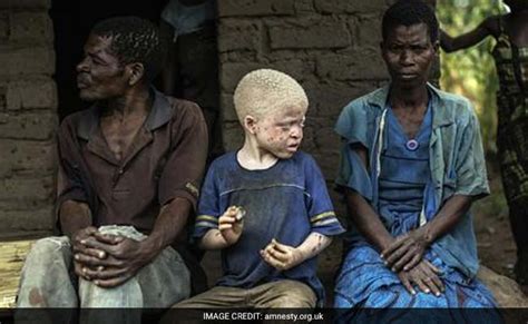 Albinos Are Being Killed In Record Numbers For Their Body Parts