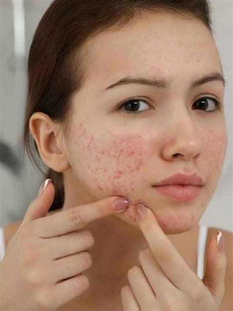 4 Valuable Ways To Beat Pimples Perpetually Taiz Mind