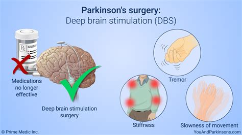 Slide Show Treatment And Management Of Parkinsons Disease