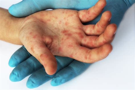 Causes Of Hand Foot And Mouth Disease