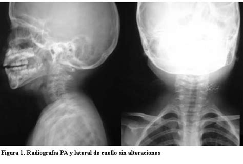 Tuberculosis Ganglionar Experiencia En El Instituto Nacional De