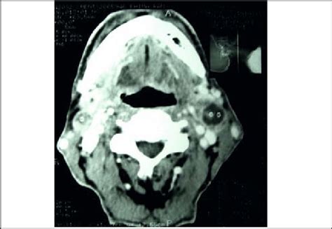 Contrast Ct Of Neck Showing Lymph Node With Central Necrosis And