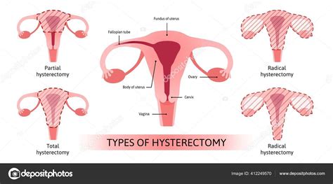 Hysterectomy Surgical Removal Uterus Medical Vector Illustration Shows