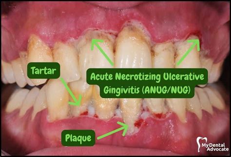 Necrotizing Ulcerative Gingivitis Before And After