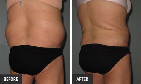 St Louis Cosmetic Surgery And Laser Lipo St Louis Liposuction Center