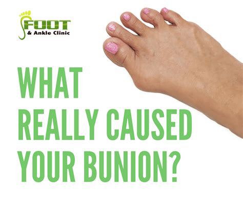 What Really Caused Your Bunion Foot And Ankle Clinic