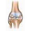 Knee Arthritis  Upswing Health