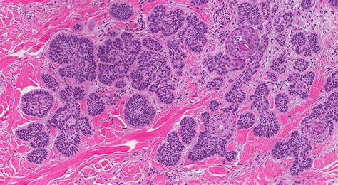 Micronodular Basal Cell Carcinoma
