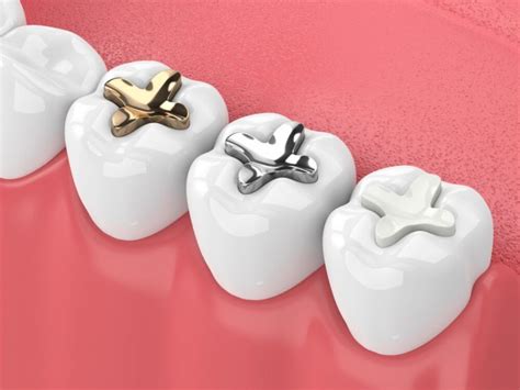 Northside Dental Clinic Pros And Cons Of Ceramic Fillings Northside