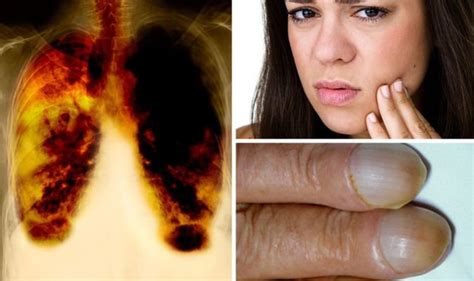 Lung Cancer Symptoms Unusual Signs Of A Tumour Include Swollen Face Express Co Uk