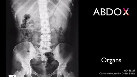 Abdo X Approach To Abdominal X Ray Interpretation Youtube