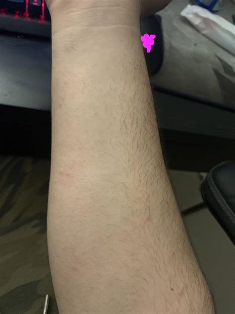 Noticed My Arm Had These Bumps Not Sure What It Is Or If I Need To See