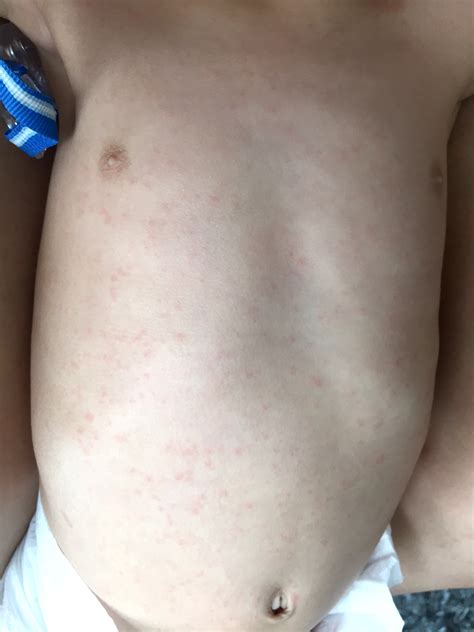 The Devil Is Roseola And How I Survived It Jo Lauren