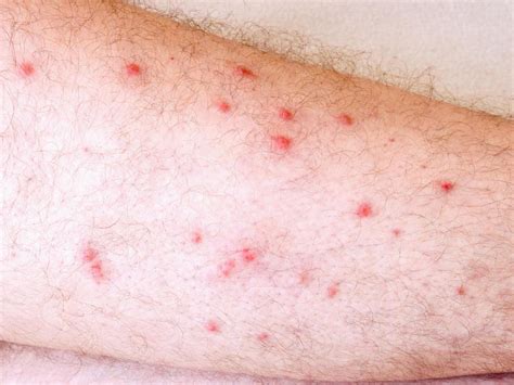 Mold Allergy Skin Rash