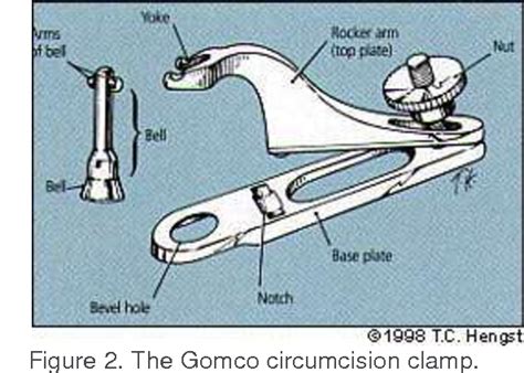 Figure 2 From The Gomco Circumcision Common Problems And Solutions