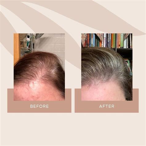 Looking for a good deal on hair serum? Hair Growth Journey in 2021 | Hair growth serum, Vegan ...