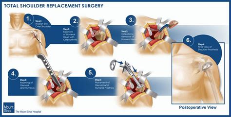 Orthopedic Surgery Orthopedics Shoulder Replacement Surgery