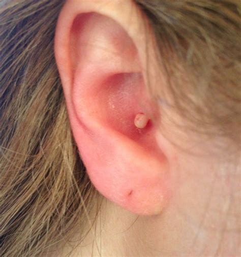 Then i heard walmart does it for $10? Pimple in Ear - Causes, Treatment, Pictures