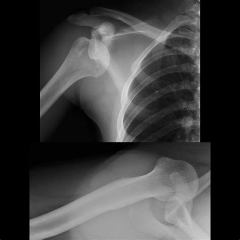 Teenager With Shoulder Pain After A Football Injury Pediatric