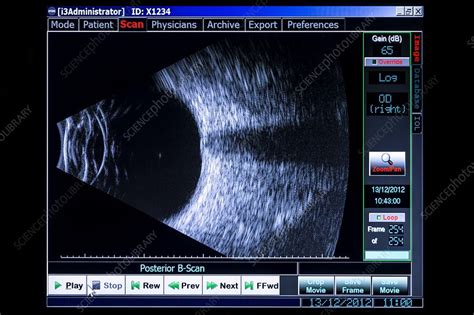 Ultrasound Eye Examination Stock Image C0163776 Science Photo