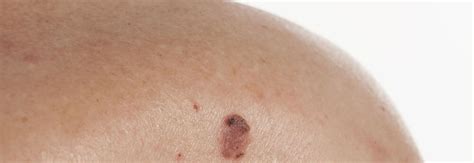 How To Spot The Symptoms Of Squamous Cell Dermatology And Mohs
