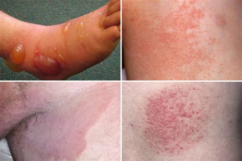 Plagued By A Summer Rash How To Tell If Its Heat Rash Or Something More Sinister The