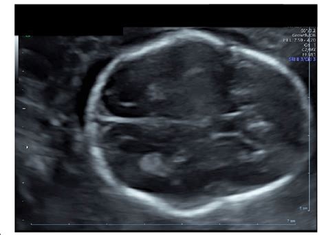 Normal Fetal Skull Ultrasound