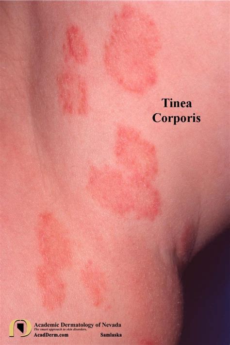 Tinea Corporis Ringworm Tinea Circinata Academic Dermatology Of Nevada