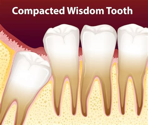 Premium Vector A Compacted Wisdom Tooth