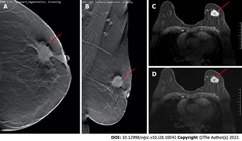 Efficacy Of Digital Breast Tomosynthesis Combined With Magnetic