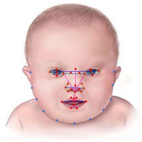 Noonan Syndrome Diagram