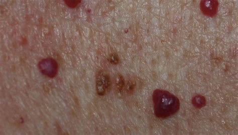 Pictures Of Spider Angiomas Angioma Grepmed Rash Smart People