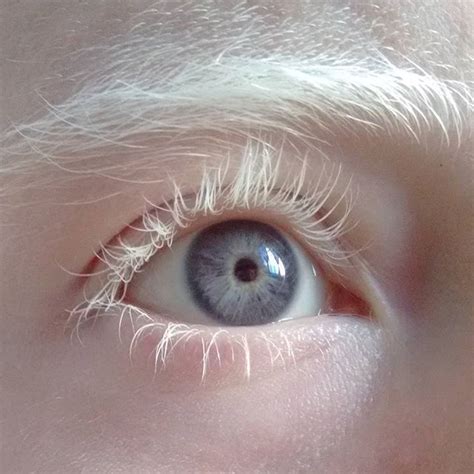 Albinismo Ocular Definición Causas Síntomas Y Más