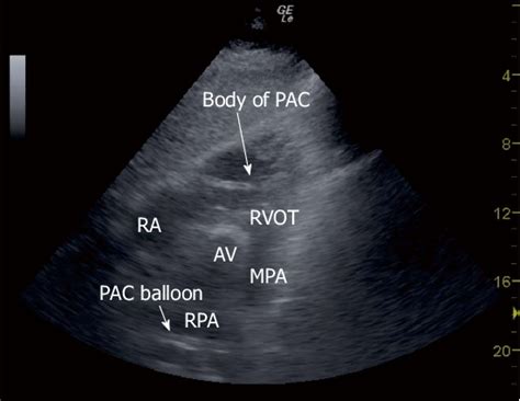 Subcostal Right Ventricular Inflow Outflow View Showing The Body Of A