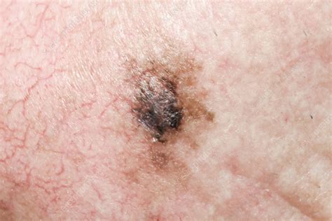 Lentigo Maligna Melanoma Stock Image C0582301 Science Photo Library