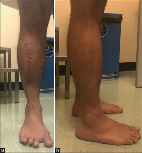 Tibialis Anterior Muscle Herniation Repaired With Trevira Tube A Surgical Technique And Review