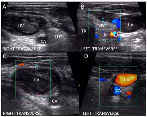 Abnormal Jugular Vein Detected During Thyroid Ultrasound