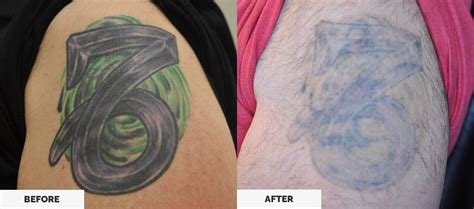 Lasers are the most common method of tattoo removal performed today. Laser Tattoo Removal - Las Vegas, Henderson, St George ...
