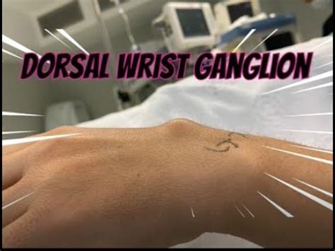 Surgical Excision Of Dorsal Ganglion Cyst YouTube