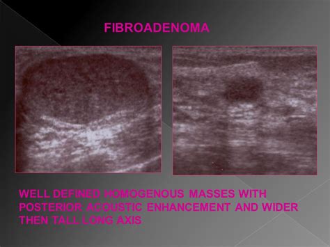Posterior Acoustic Shadowing Breast Ultrasound Ultrasound Shows A