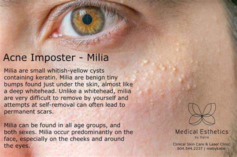 What Causes Milia There Are Several Factors That Cause Milia In Adults