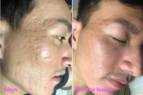 Acne Scar Treatment In Singapore The Only Solution To Your Disheartened